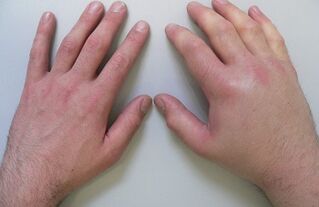 Η αρθραλγία ως αιτία πόνου στις αρθρώσεις των δακτύλων