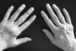 νόσος των χεριών